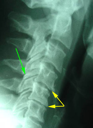 disc degeneration treated at Dr. Le's Chiropractic & Wellness, L.L.C.