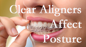 Clear aligners influence posture which Auburn chiropractic helps.