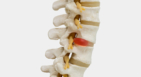 Auburn chiropractic conservative care helps even huge disc herniations go away