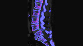 Dr. Le's Chiropractic & Wellness, L.L.C. is aware that inflammatory spinal gout is a differential diagnosis to consider for patients who present with back pain and other spine related symptoms.