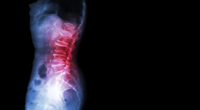 Auburn Chiropractic Care of Spondylolisthesis 