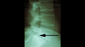 Auburn spondylolisthesis 