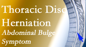 Dr. Le's Chiropractic & Wellness, L.L.C. treats thoracic disc herniation that for some patients prompts abdominal pain.