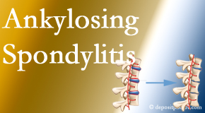 Dr. Le's Chiropractic & Wellness, L.L.C. offers gentle chiropractic spinal manipulation in the form of Cox Technic for ankylosing spondylitis management.