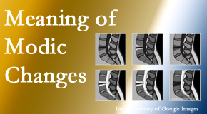 Dr. Le's Chiropractic & Wellness, L.L.C. sees many back pain and neck pain patients who bring their MRIs with them to the office. Modic changes are often noted. 