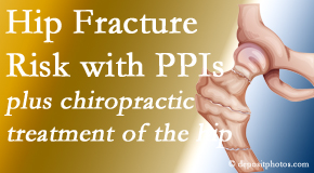 Dr. Le's Chiropractic & Wellness, L.L.C. shares new research describing increased risk of hip fracture with proton pump inhibitor use. 