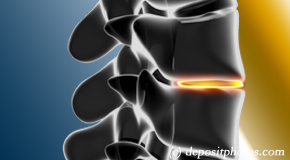 Auburn degenerative spinal changes 