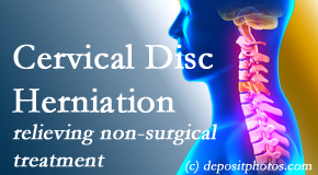 Dr. Le's Chiropractic & Wellness, L.L.C. uses the Cox® Technic spinal manipulation to treat cervical radiculopathy and avert surgery. 