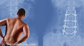 Auburn chiropractic relief for back pain after back surgery