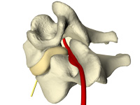 cervical spine pain due to disc herniation