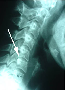 cervical spine instability