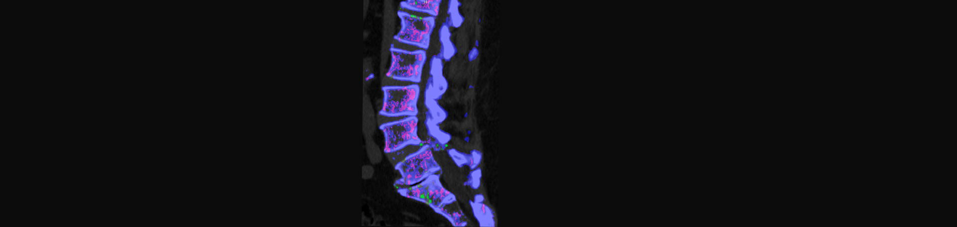 Dr. Le's Chiropractic & Wellness, L.L.C. is aware that inflammatory spinal gout is a differential diagnosis to consider for patients who present with back pain and other spine related symptoms.