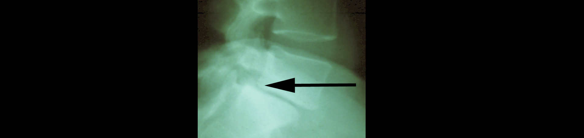 Auburn spondylolisthesis 