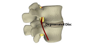 degenerated disc image