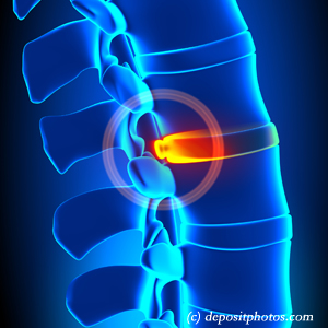 picture of lumbar Auburn disc herniation