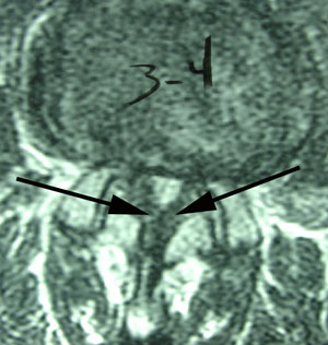 ligamentum flavum hypertrophy