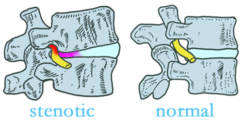 Auburn stenotic and normal spinal discs